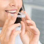 aparate dentare transparent